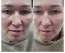 Идеальная кожа — без уколов