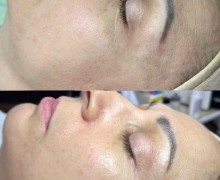 Идеальная кожа — без уколов