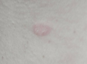 В мире признаки новой эпидемии: по Европе стремительно распространяется опасный генитальный супергрибок